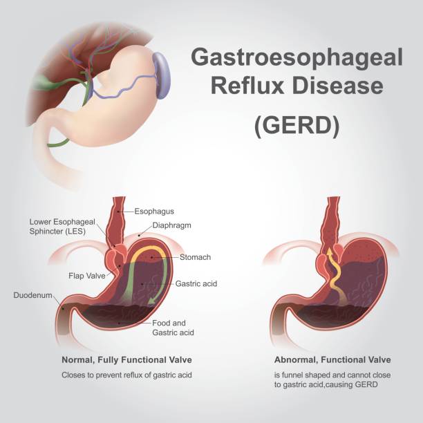 Gastroesophageal Reflux