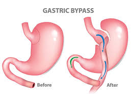 gastric bypass