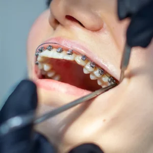Self-Ligating