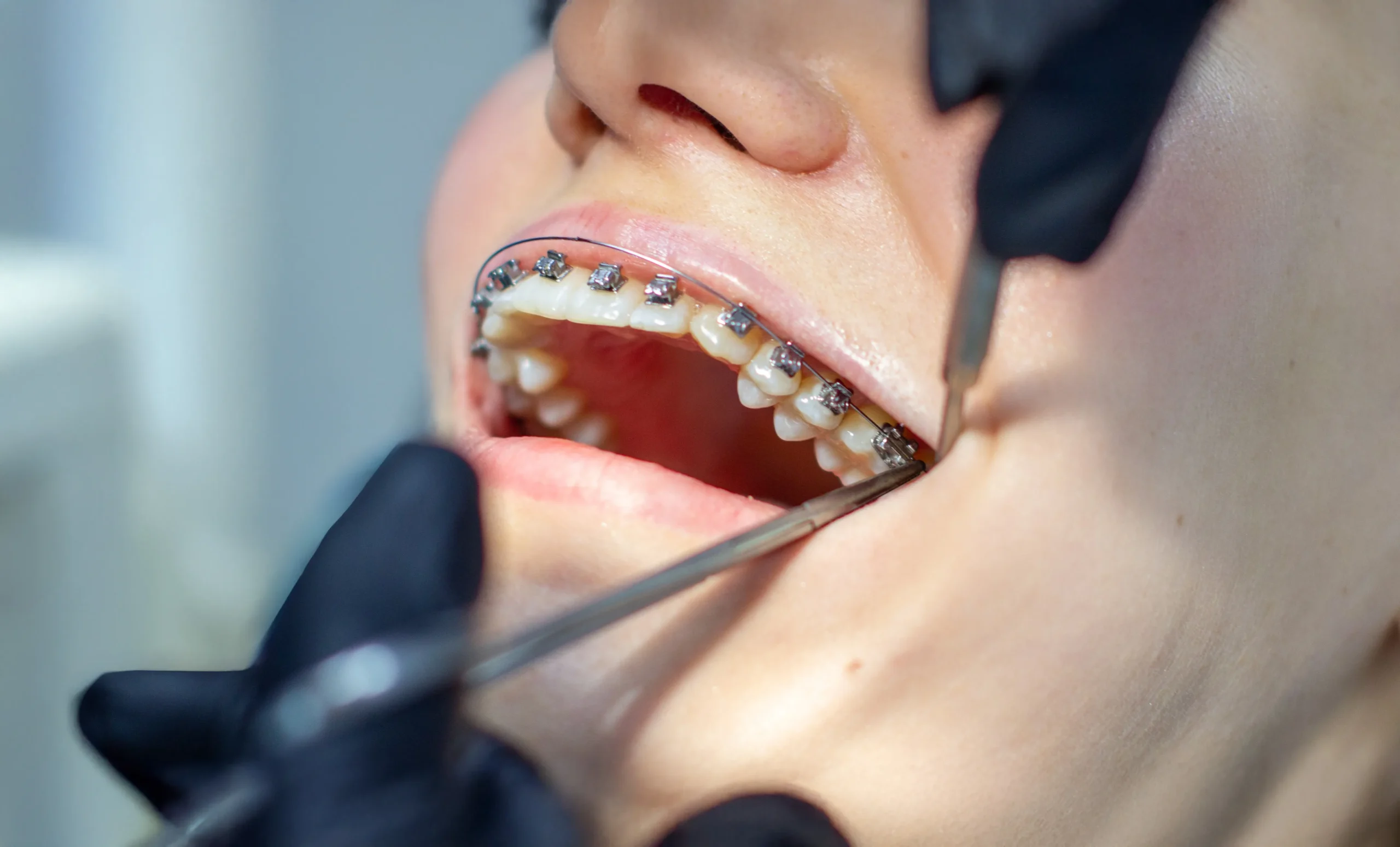 Self-Ligating